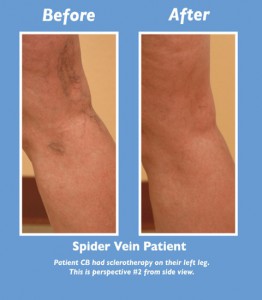 Side View of Spider Vein Treatment