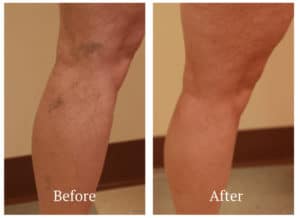 Sclerotherapy Before and After | Albuquerque & Santa Fe