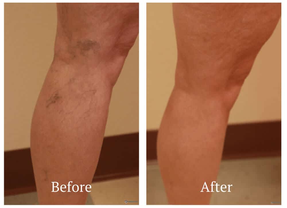 Sclerotherapy before and after | Albuquerque & Santa Fe