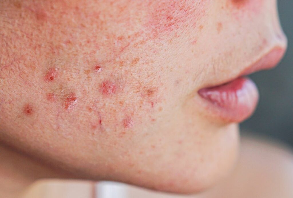 What is the Best Laser Treatment for Rosacea? Albuquerque