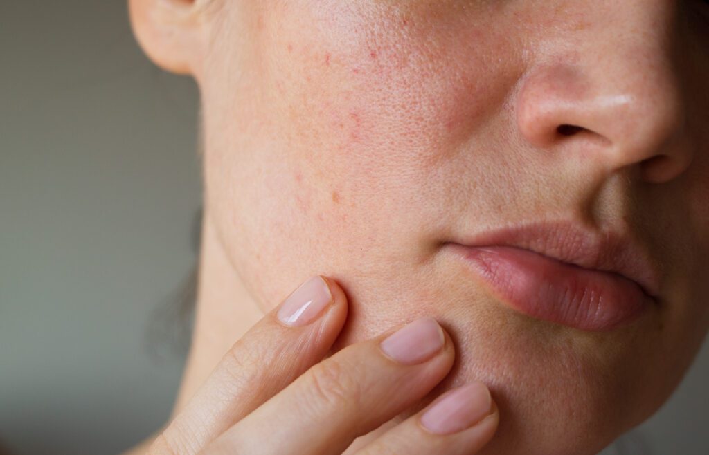 Acne Scars Albuquerque,