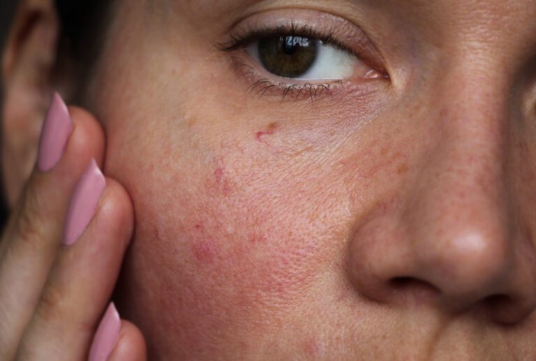 Acne Scars Albuquerque,